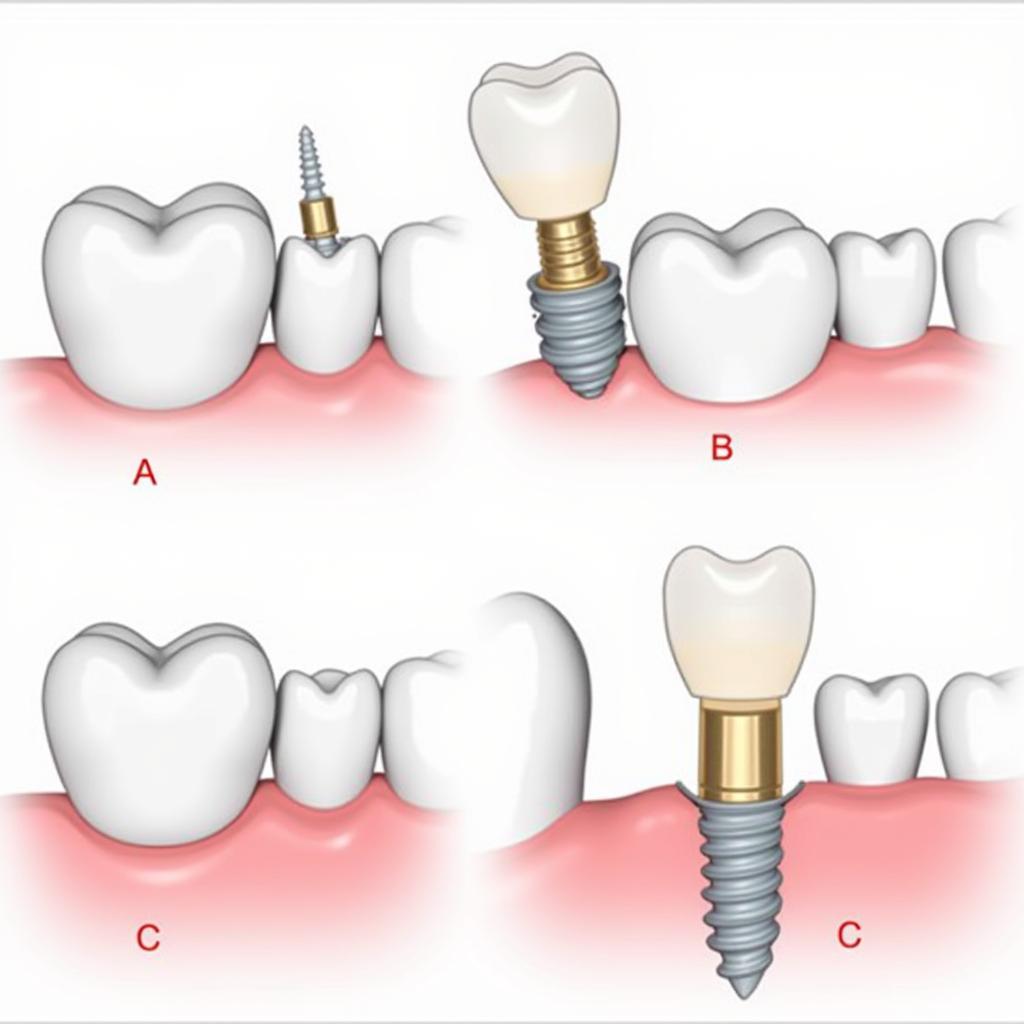 Hình ảnh minh họa quy trình trồng răng Implant